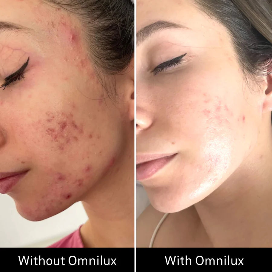 Omnilux Clear Face Mask - Medical Grade LED Light Therapy for Acne