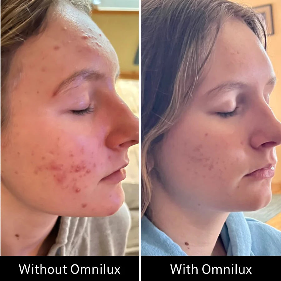 Omnilux Clear Face Mask - Medical Grade LED Light Therapy for Acne