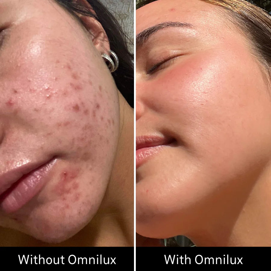 Omnilux Clear Face Mask - Medical Grade LED Light Therapy for Acne