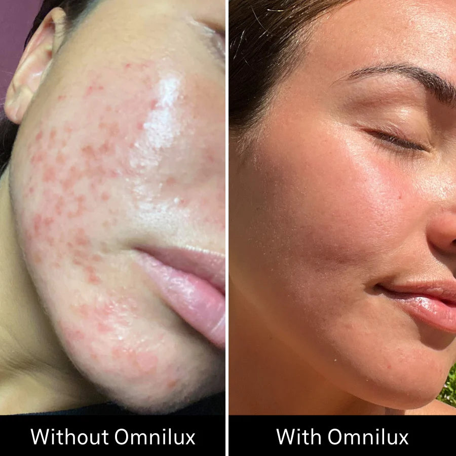 Omnilux Clear Face Mask - Medical Grade LED Light Therapy for Acne