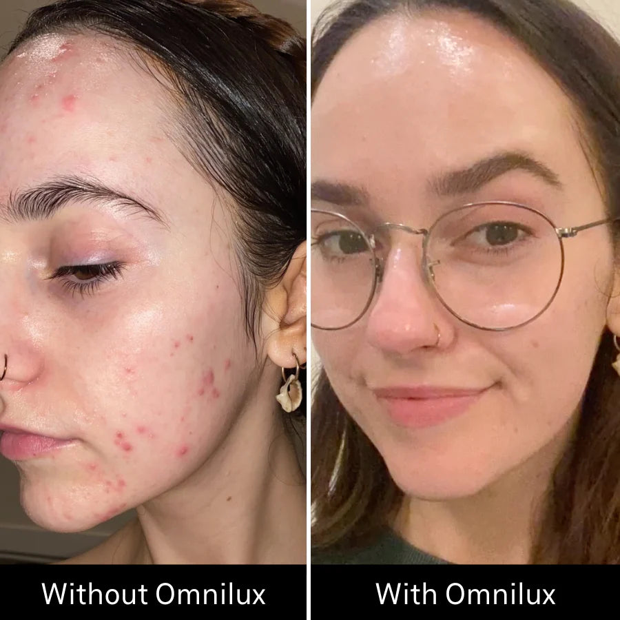 Omnilux Clear Face Mask - Medical Grade LED Light Therapy for Acne