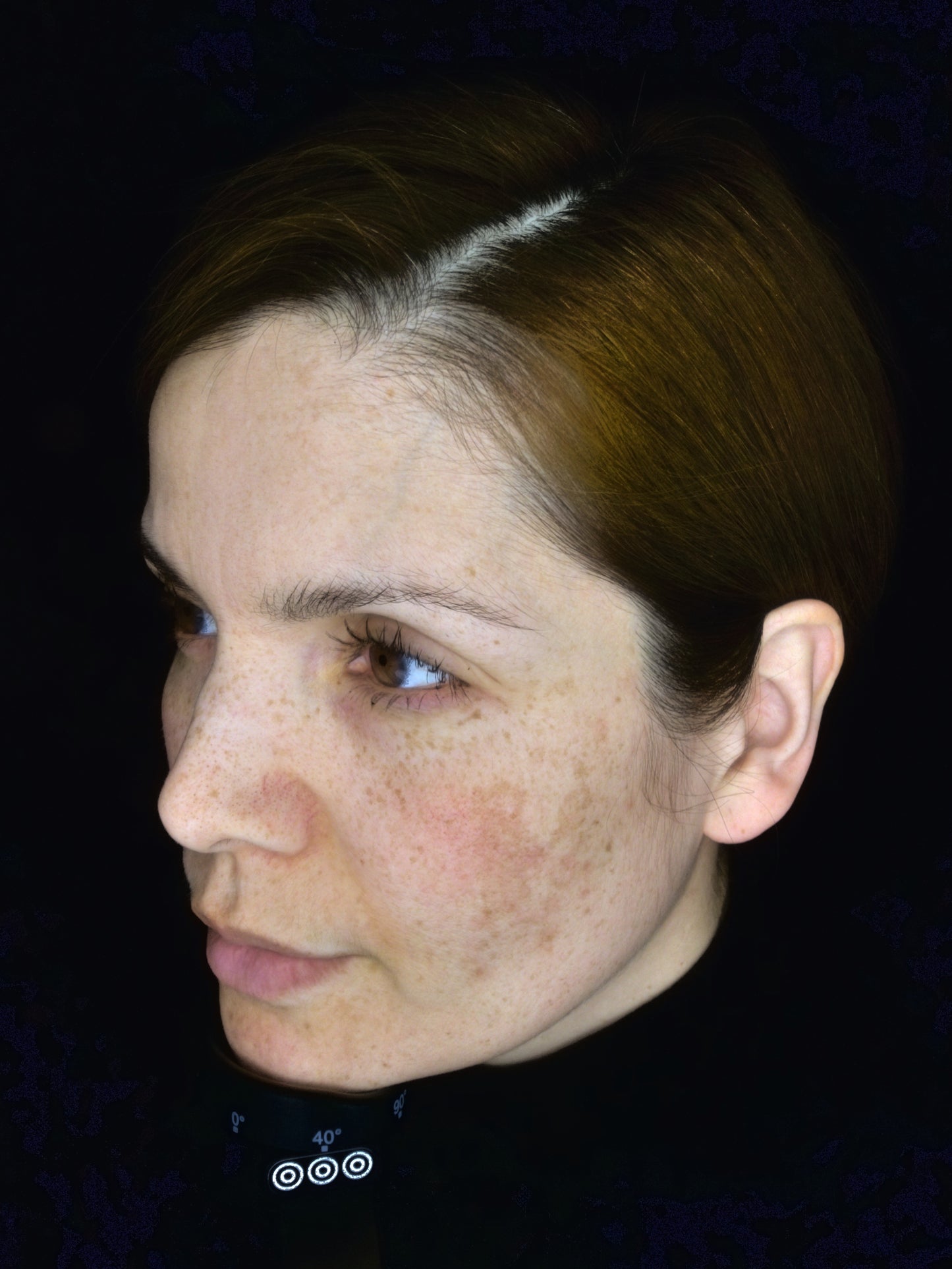 OBSERVE 520 Skin Analyst Face Imaging - your 1st appointment