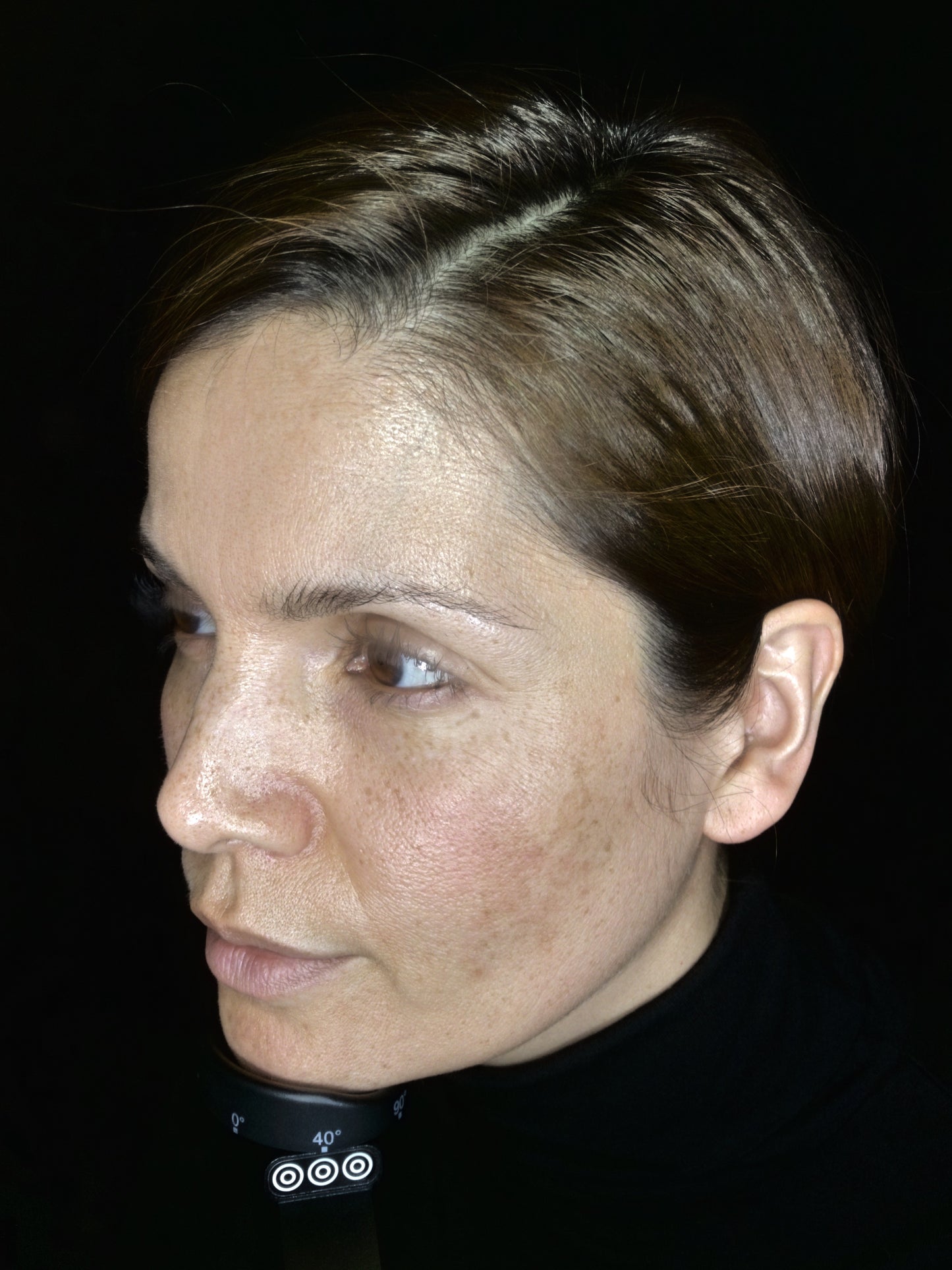 OBSERVE 520 Skin Analyst Face Imaging - your 1st appointment