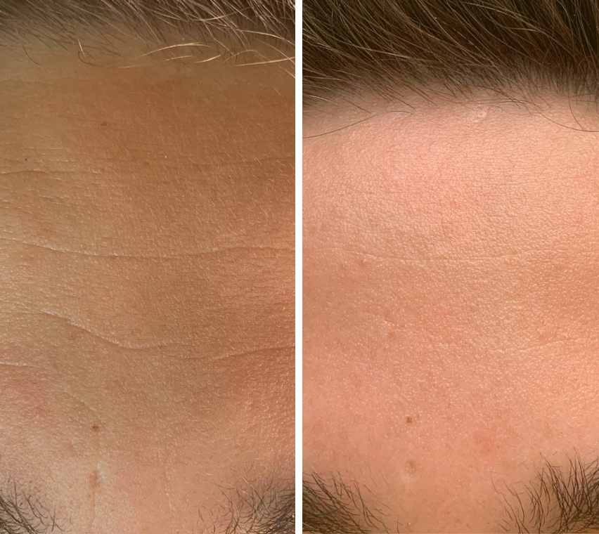 Omnilux Men Face Mask - Medical Grade LED Light Therapy