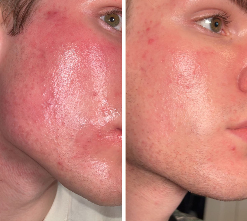 Omnilux Men Face Mask - Medical Grade LED Light Therapy