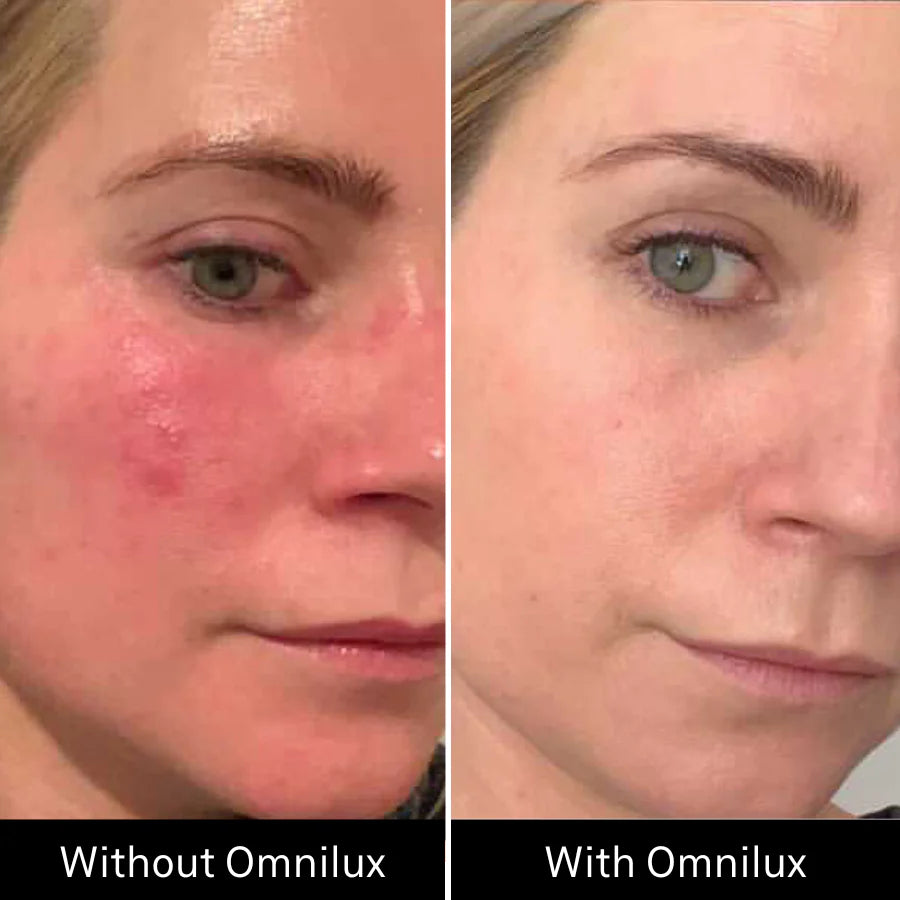 Omnilux Contour Face Mask - Medical Grade LED Light Therapy
