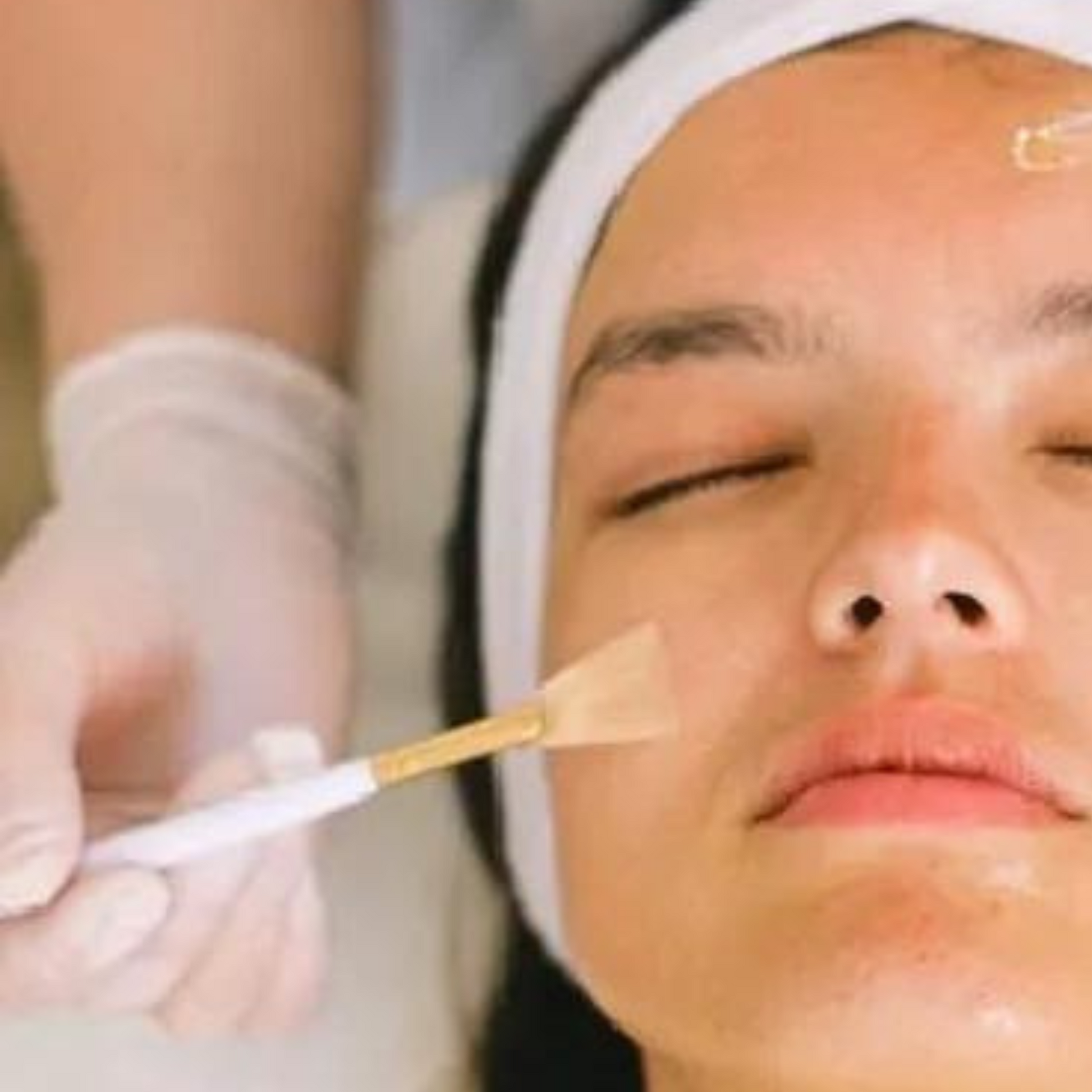 Our acne peel is a specialized skin treatment designed to combat acne and restore your skin's natural beauty. Our team of experienced professionals will carefully analyze your skin type and design a customized peel, our acne peel deeply penetrates your skin to clear out impurities and reduce inflammation.  our peel will help to reduce the appearance of blemishes, prevent future breakouts and leave your skin feeling refreshed and rejuvenated.