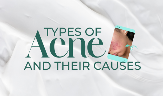 Types of Acne and Their Causes. Your Guide to Effective Treatment!