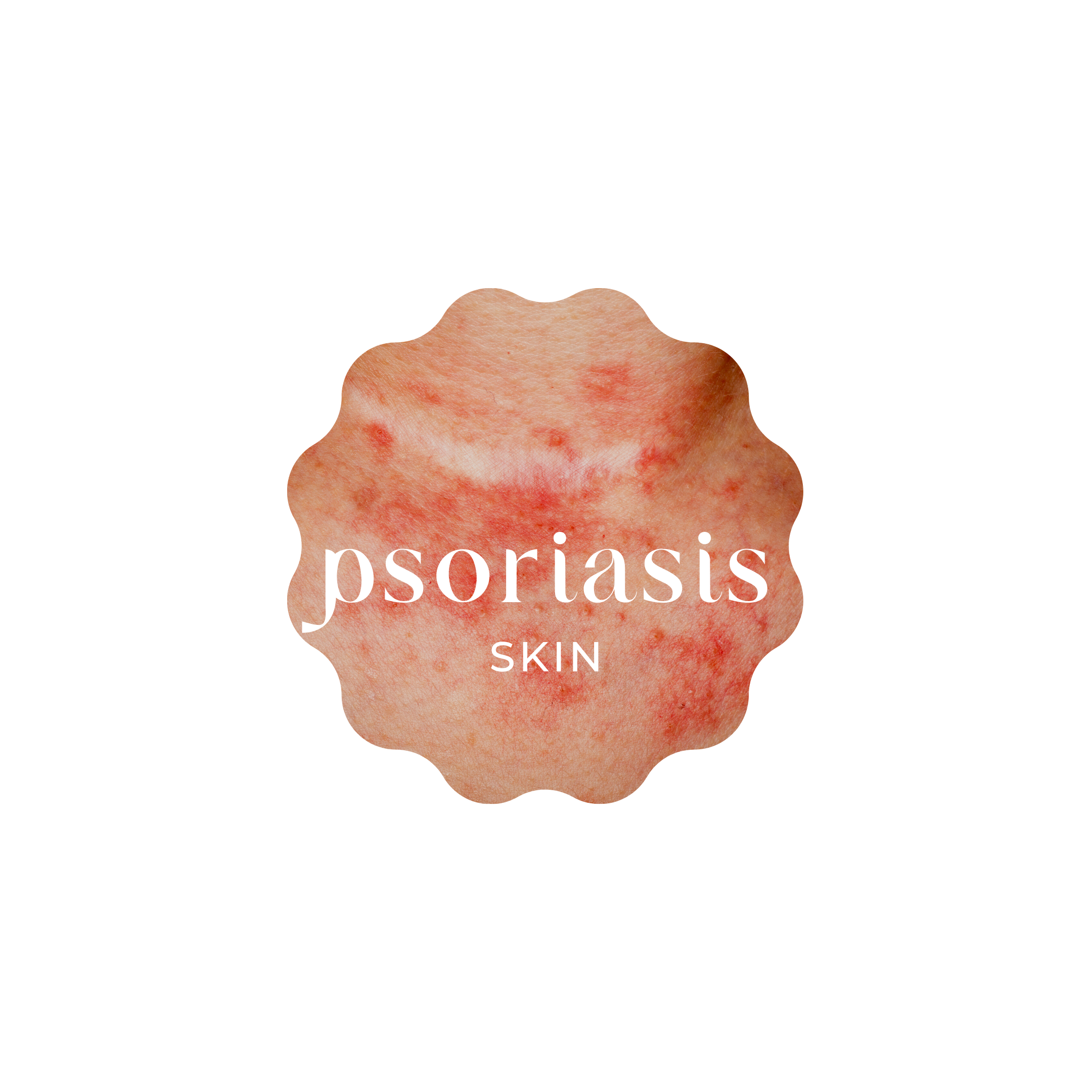 Products Treatments For Psoriasis Skin Condition Narellan Skin Salon Clinic Australian 