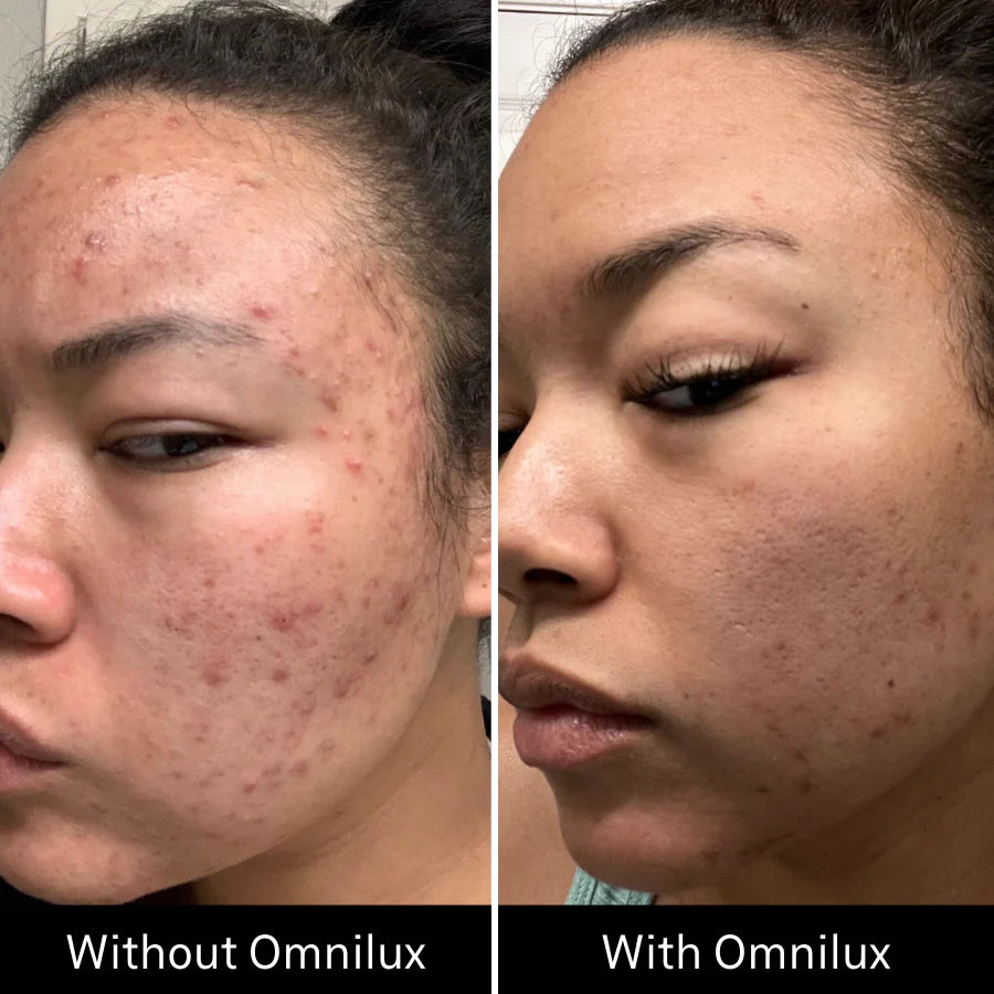 Omnilux Clear Face Mask - Medical Grade LED Light Therapy for Acne