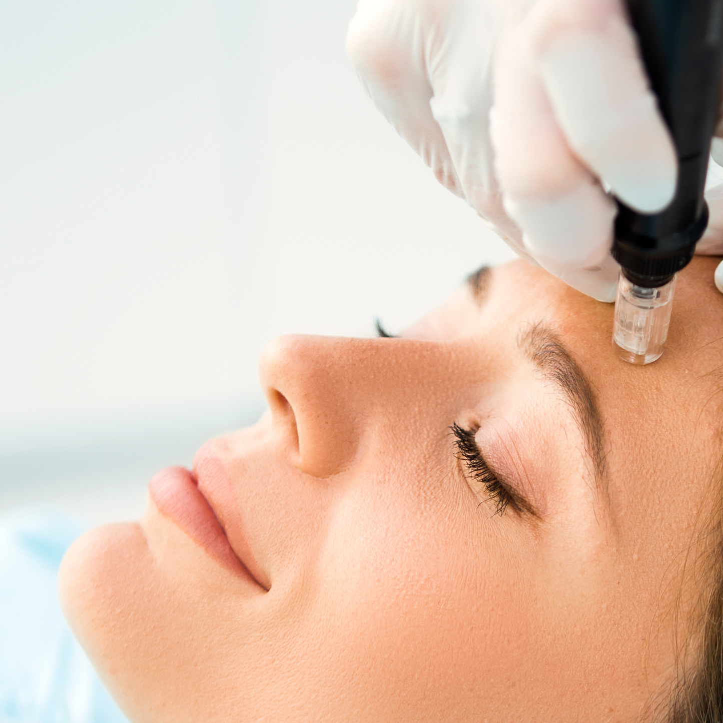 Here are a few of the benefits associated with skin needling treatments:  Minimises the appearance of ACNE scars  Reduces the appearance of WRINKLES  Quick and painless procedure  Improves pigmentation and MELASMA  Improves STRETCH MARKS  Minimal downtime  Improve skin health and luminosity  Proven Results